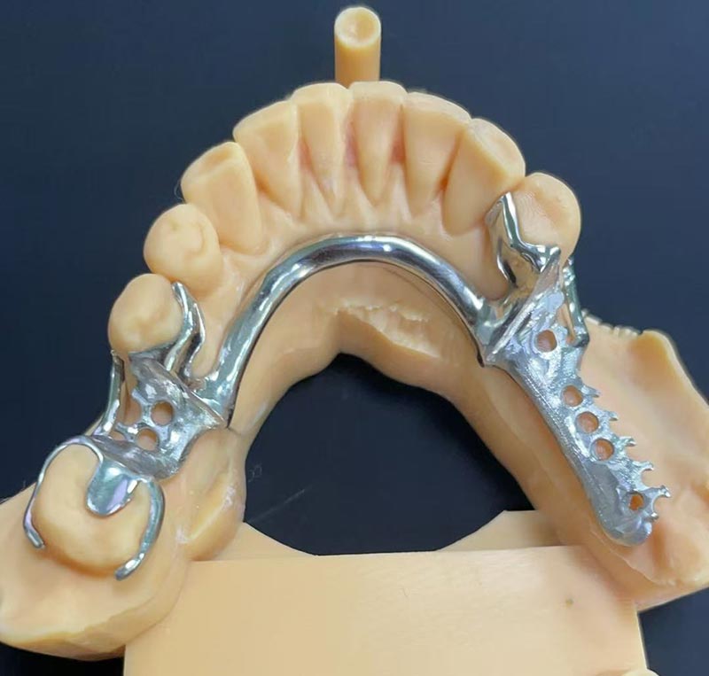 Kobalto-Kromo Markoaren abantailak (Co Cr Markoa)