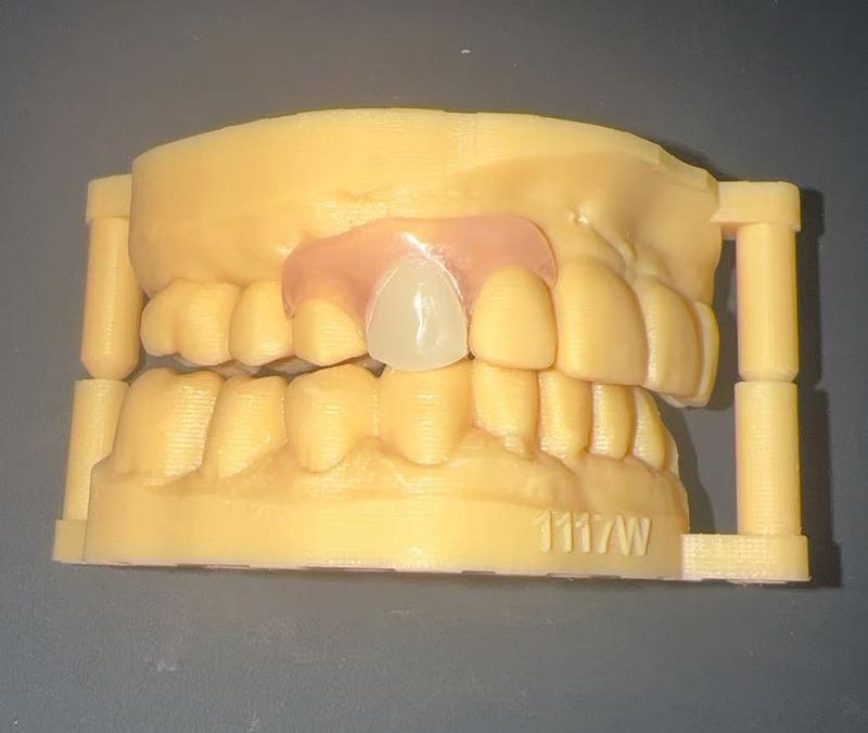 Dentadura partziala malgua: Chinese Dental Lab eta WM Dental Lab-en zaharberritze estetiko eta erosoa