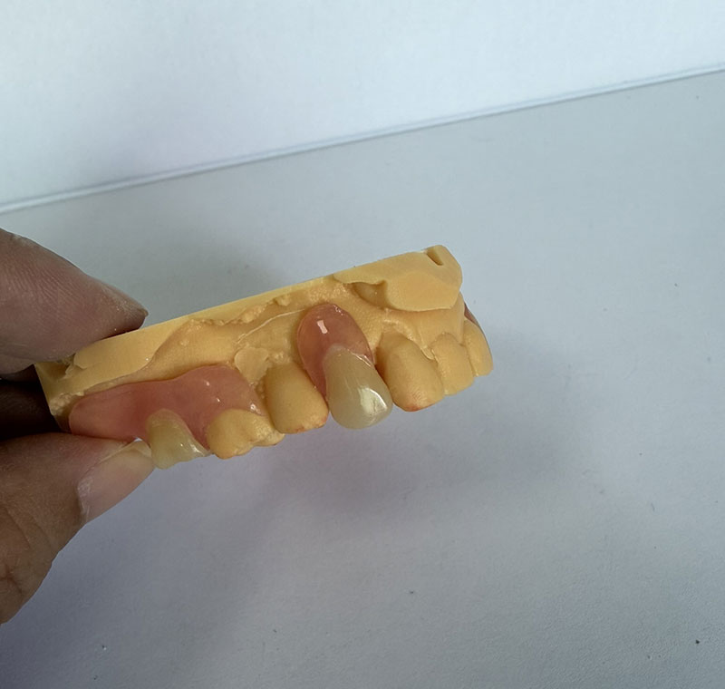 Valplast Partzialak WM Dental Lab-en