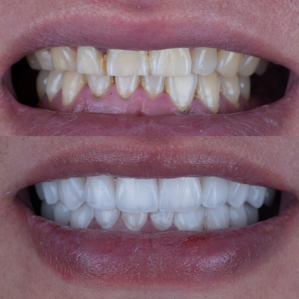 Emax Layered Veneers Estetika Txinako Hortz Laborategiko lana