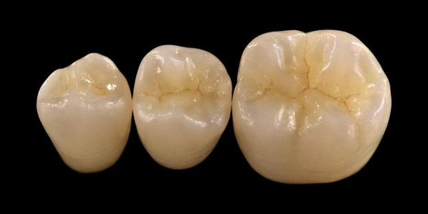 <h2>Zirkonia Odontologian: adierazpenak, abantailak eta gogoeta klinikoak</h2>
<p>Zirkonia oso ezaguna da bere indarra eta iraunkortasunagatik. Zirkoniazko materialen azken belaunaldiek propietate estetikoak nabarmen hobetu dituzte. Zeramika osoko zaharberritzeak kontuan hartzen dituzten pazienteentzat, ezinbestekoa da zirkonioan oinarritutako sistemen zantzuak eta mugak arretaz ebaluatzea.</p>
<p>Gaur egungo pazienteek gero eta gehiago espero dituzte estetika bikaina eta errendimendu funtzional osoa uztartzen dituzten zaharberritzeak. Zeramikazko sistema moderno gehienek itxaropen horiek bete ditzakete, baina arrakasta klinikoa, neurri handi batean, materialaren hautaketa egokiaren, hortzak prestatzearen eta zementazio-protokoloaren araberakoa da. Hausturaren erresistentzia, flexio-erresistentzia, higadura erresistentzia eta epe luzerako egonkortasuna bezalako funtsezko propietateek gidatu behar dute aukeraketa. Material horien artean, zirkonia gaur egungo odontologia zaharberritzailean gehien erabiltzen den aukeretako bat bihurtu da.</p>
<h3>Zergatik aukeratu Zirconia?</h3>
<p>Zirkonia bere indar bikainagatik eta epe luzerako iraunkortasunagatik estimatzen da. Zirkonia modernoa aurreko belaunaldiekiko nabarmen desberdina da, opakuagoak eta estetiko gutxiagokoak ziren. Gaur egun, CAD/CAM teknologiak zirkoniazko zaharberritzeen fabrikazio zehatza ahalbidetzen du, propietate optiko hobeak dituztenak.</p>
<p>Zaharberritzeak honela diseinatu daitezke:</p>
<ul>
<li><strong>Zirkonia monolitikoa:</strong>Atzeko koroa eta zubietarako aproposa, sendotasun eta iraunkortasun handia eskainiz.</li>
<li><strong>Geruzadun zirkonia:</strong>Estetika hobetua eskatzen duten kasuetarako aproposa, ahoaren eremu ezberdinetan luzerako zaharberritzeak barne.</li>
</ul>
<p>Flexur-erresistentzia motaren arabera aldatzen da, gutxi gorabehera 590 MPa-tik gardentasun handiko zirkoniatan 1400 MPa-ra arte forma monolitikoetan. Zirkoniazko zaharberritzeak zementatu daitezke erretxin-zementu auto-itsasgarriak edo erretxinaz eraldatutako beira-ionomero-zementuak erabiliz.</p>
<h3>Zirkonia-materialen aukeraketan funtsezko faktoreak</h3>
<p>Zeramika osoko zaharberritze baterako zirkonia kontuan hartuta, medikuek hainbat faktore kritiko ebaluatu behar dituzte:</p>
<ul>
<li>Gainerako hortzaren egitura</li>
<li>Kokapen aho-barrunbean (zona estetikoa vs eremu funtzionala)</li>
<li>Bruxismoa bezalako ohitura parafuntzionalen presentzia</li>
<li>Aldameneko hortz naturalen gardentasuna</li>
<li>Azpiko hortzaren egituraren kolorea eta egoera</li>
</ul>
<p>Zona estetikoak normalean aurreko hortzak barne hartzen ditu, nahiz eta paziente batzuetan lehen molarera heda daitekeen irribarrearen lerroaren eta aurpegiko dinamikaren arabera. Eremu funtzionalak, oro har, premolarrak eta molarrak biltzen ditu, non indar oklusalak nabarmen handiagoak diren.</p>
<h3>Zona Funtzionaleko Aplikazioak</h3>
<p>Atzeko eskualdeetan, indar oklusalak arretaz kontuan hartu behar dira. Zirkonia PFM zaharberritze tradizionalen alternatiba bikaina da, batez ere zaharberritze-espazio mugatua duten kasuetan. Zirkonia monolitiko modernoak anatomia oklusalaren ingerada osoko diseinua ahalbidetzen du, kuspi funtzionalak eta ertz marjinalak barne, indar handia mantenduz.</p>
<p>Egungo frogak erakusten dute zirkonia monolitikoa ondo egokia dela atzeko koroetarako eta unitate anitzeko zubietarako, haustura eta higadurarako erresistentzia bikaina dela eta. Itsatsi-tekniken eta prestaketaren diseinuaren aurrerapenek epe luzeko emaitza klinikoak ere hobetu dituzte.</p>
<h3>Zona Estetikoko Aplikazioak</h3>
<p>Aurreko eskualdean, zaharberritzeek hortz naturalaren kolorea, gardentasuna eta argiaren portaera hurbiletik errepikatu behar dituzte. Litio disilikatua bezalako materialek estetika bikaina eskaintzen duten arren, ez dira hain sendoak eta normalean lotura itsasgarria behar dute.</p>
<p>Zirkoniaren abantaila nagusi bat ohiko zementua izateko gaitasuna da, oraindik ere errendimendu estetiko handia lortuz. Gardentasun handiko eta geruza anitzeko zirkonia sistemen garapenarekin, orain posible da hortz naturala estuki imitatzen duten zaharberritzeak ekoiztea.</p>
<p>Prozesatzeko teknika aurreratuek propietate optikoak areagotzen dituzte eta argiaren transmisioan eta itxuran eragina izan dezaketen akatsak murrizten dituzte.</p>
<h3>Indarra eta Estetika konbinatuta</h3>
<p>Zirkoniako lehen sistemek indarra lehenesten zuten baina kalitate estetikoa falta zuten. Zirkonia monolitiko modernoak arrakastaz konbinatzen ditu indarra eta itxura hobetua, eta kasu kliniko ugaritarako egokia da.</p>
<p>Bereziki onuragarria da ohitura parafuntzionalak edo aurreko zaharberritze akatsak dituzten pazienteentzat. Azterketa klinikoek pazienteen onarpen handia eta konplikazio tasa baxuak adierazten dituzte.</p>
<p>Kontrako hortzarekiko higadurari buruzko kezkak formulazio berriekin murriztu dira. Oso leundutako zirkonia gainazalek urratzaile potentzial txikia erakusten dute, eta kasu batzuetan portzelanaz fusionatutako metalezko zaharberritze tradizionalek baino leunagoak izan daitezke.</p>
<h3>Zirkonia inplanteak: Sortzen ari den alternatiba</h3>
<p>Titaniozko inplanteak estandar klinikoa izaten jarraitzen duten bitartean, zirkoniazko inplanteak arreta irabazten ari dira metalik gabeko alternatiba gisa. Lehen diseinuak pieza bakarreko sistemak ziren batez ere, baina bi piezako zirkonia inplanteek orain malgutasun protesikoaren hobekuntza ahalbidetzen dute.</p>
<p>Zirkonia inplanteak bereziki erabilgarriak dira arazo estetikoak dauden kasuetan, hala nola, peri-inplanteen ehunen kolore gris potentziala edo biotipo gingibal mehea. Titaniozko sentikortasun arraroa duten pazienteentzat ere kontuan hartu daitezke.</p>
<p>Hala ere, zirkonia-inplanteak nahiko berriak dira oraindik, eta epe luzerako datu klinikoak mugatuak dira titaniozko sistemekin alderatuta.</p>
<h3>Ondorioa</h3>
<p>Zirkonia material polifazetikoa bihurtu da zaharberritze-odontologian, errendimendu mekanikoaren eta estetikaren arteko oreka sendoa eskainiz. Kasu egokiak hautatzea eta protokolo klinikoei jarraitzea ezinbestekoak dira emaitza optimoak lortzeko aurreko zein atzeko aplikazioetan.</p>